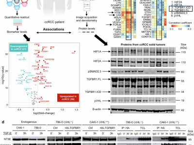 Figure from “Liquid biomarkers associate with TGF-β Type I receptor and hypoxia in kidney cancer” (Mallikarjuna et al., 2025), published in Signal Transduction and Targeted Therapy. DOI: 10.1038/s41392-025-02404-7